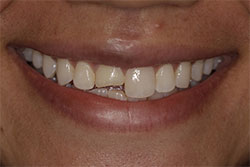 Close up of smile before cosmetic dental bonding