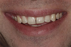 Close up of smile before cosmetic dental bonding