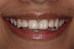 Close up of smile after cosmetic dental bonding