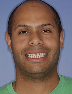 Smiling man with imperfect teeth