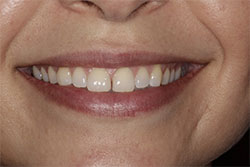Smiling young woman with imperfect teeth