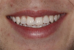 Close up of smile after cosmetic dental bonding