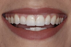 Close up of smile with no gaps between any teeth