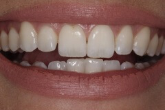 Close up of smile with small gaps between some teeth