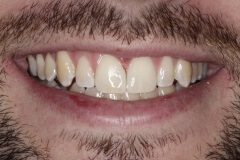 Close up of man smiling with tooth gap closed