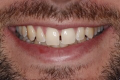 Close up of man smiling with gap between two front teeth