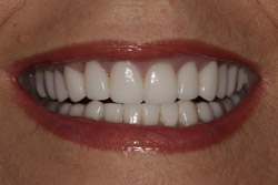 Close up of smile with flawless teeth after treatment from North Dallas dentist
