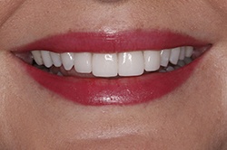 Close up of smile with flawless teeth
