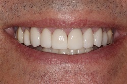 Close up of smile with flawless teeth thanks to veneers in North Dallas