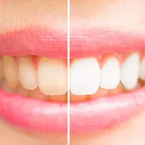 Closeup of patient's teeth before and after whitening treatment