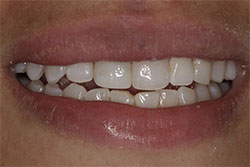 Close up of smile after cosmetic dental bonding