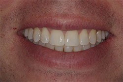 Close up of smile after cosmetic dental bonding