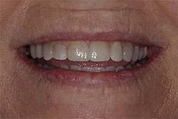 Close up of smile after cosmetic dental bonding