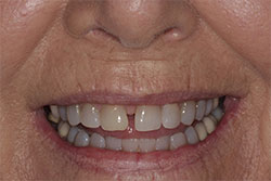 Close up of smile before cosmetic dental bonding