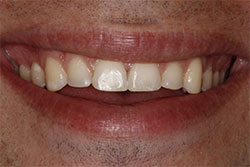 Close up of smile after cosmetic dental bonding