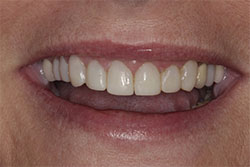 Close up of smile after cosmetic dental bonding