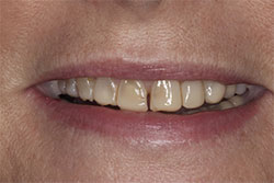 Close up of smile before cosmetic dental bonding