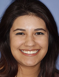 Smiling young woman with flawless teeth