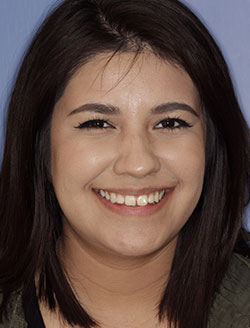 Smiling young woman with imperfect teeth