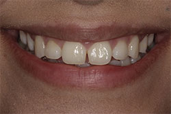 Close up of smile before cosmetic dental bonding