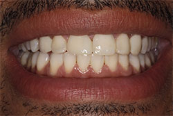 Close up of smile after cosmetic dental bonding