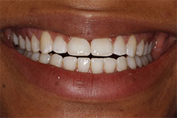 Close up of smile after cosmetic dental bonding