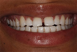 Close up of smile before cosmetic dental bonding