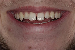 Close up of smile before cosmetic dental bonding