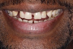 Close up of smile with imperfect teeth