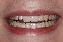 Close up of smile with imperfect teeth