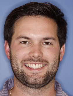 Dental patient smiling with flawless teeth