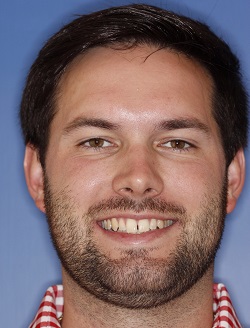 Dental patient smiling with imperfect teeth