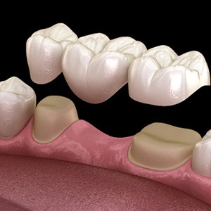 A 3D illustration of a traditional dental bridge