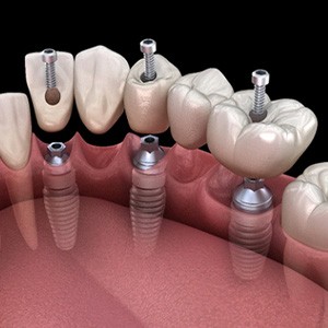 A 3D illustration of an implant dental bridge