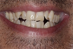 Close up of smile with imperfect teeth
