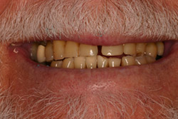 Close up of smile with imperfect teeth