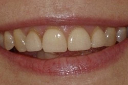 Close up of smile with imperfect teeth