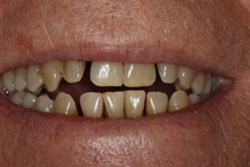 Close up of smile with imperfect teeth