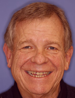 Dental patient smiling with imperfect teeth