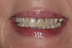 Close up of smile with imperfect teeth