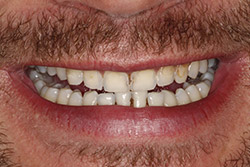 Close up of smile with imperfect teeth