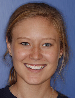 Young woman smiling with flawless teeth