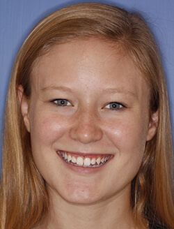 Dental patient smiling with imperfect teeth