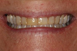 Close up of smile with imperfect teeth