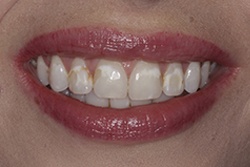 Close up of smile with imperfect teeth