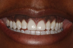 Close up of smile with flawless teeth