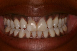 Close up of smile with imperfect teeth