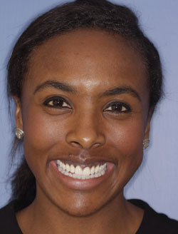 Dental patient smiling with flawless teeth