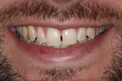 Close up of smile with imperfect teeth