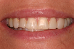 Close up of smile with imperfect teeth